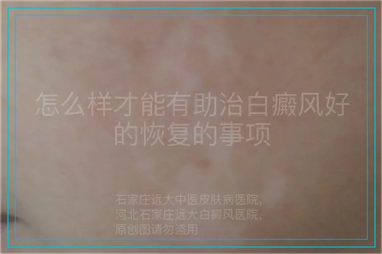 怎么样才能有助治白癜风好的恢复的事项