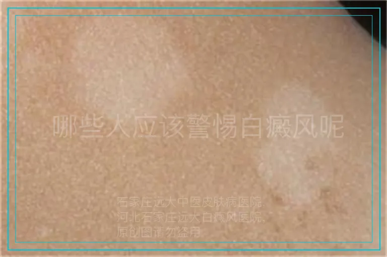 哪些人应该警惕白癜风呢