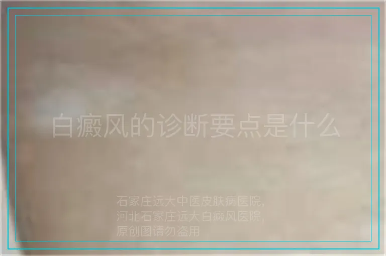 白癜风的诊断要点是什么