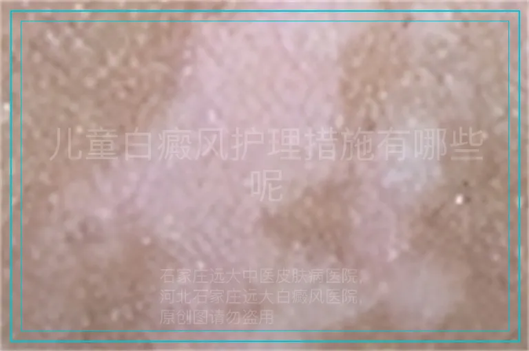 儿童白癜风护理措施有哪些呢