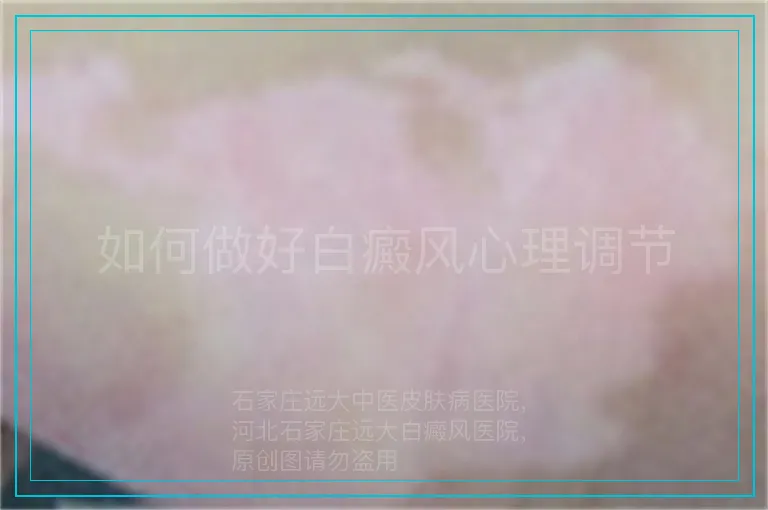 如何做好白癜风心理调节