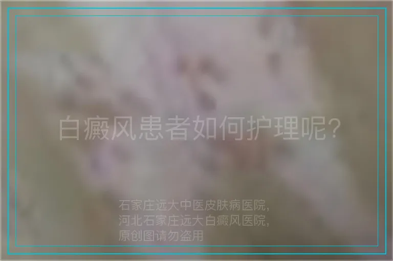 白癜风患者如何护理呢?