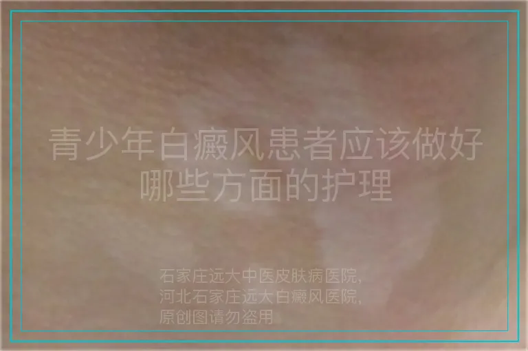 青少年白癜风患者应该做好哪些方面的护理