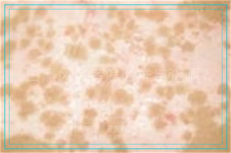 白癜风患者怎么样自查呢?