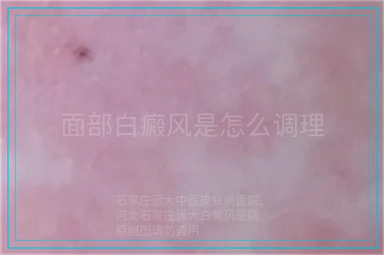 面部白癜风是怎么调理