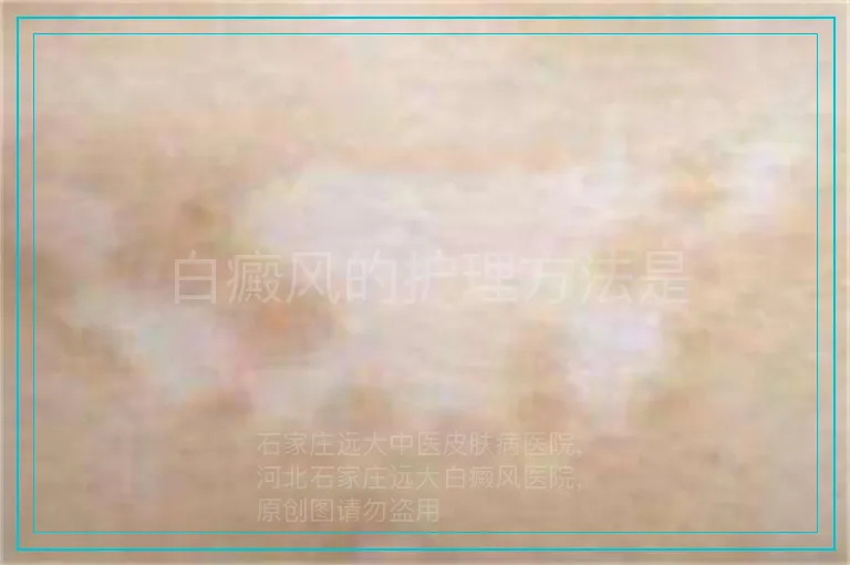 白癜风的护理方法是