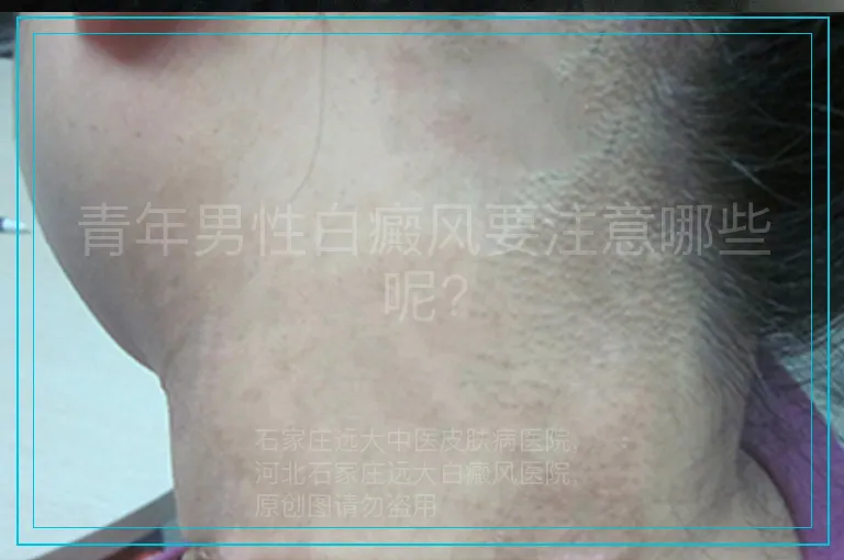 青年男性白癜风要注意哪些呢?