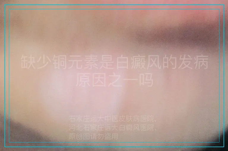 缺少铜元素是白癜风的发病原因之一吗