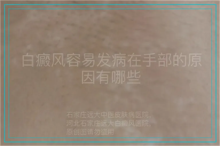 白癜风容易发病在手部的原因有哪些