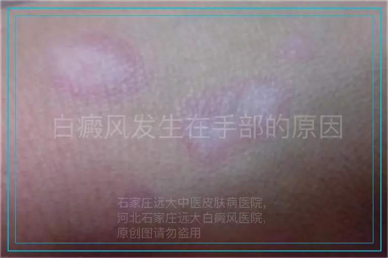 白癜风发生在手部的原因