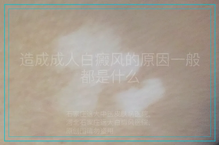 造成成人白癜风的原因一般都是什么
