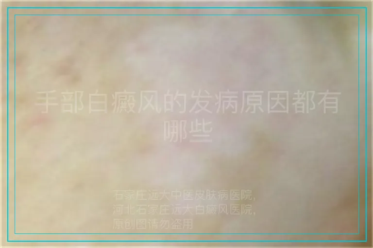 手部白癜风的发病原因都有哪些