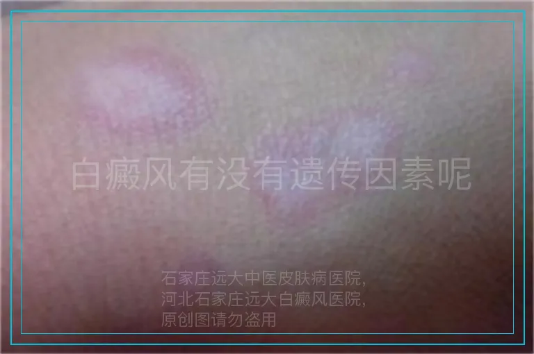白癜风有没有遗传因素呢