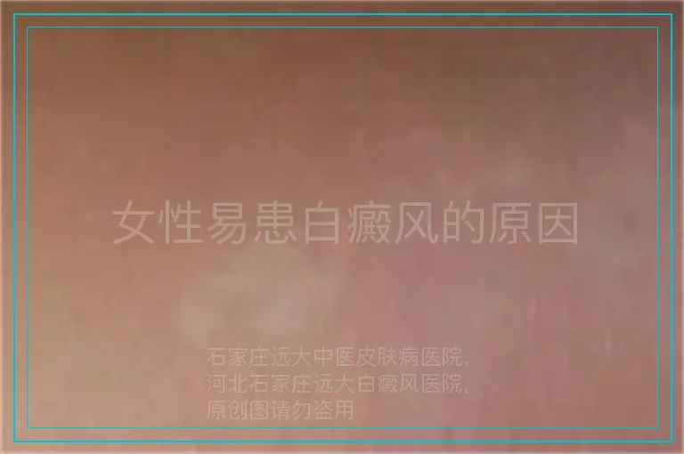 女性易患白癜风的原因