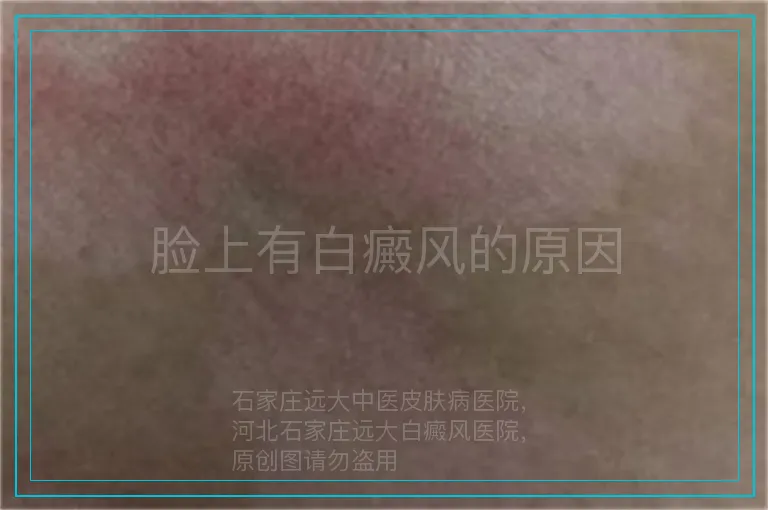 脸上有白癜风的原因
