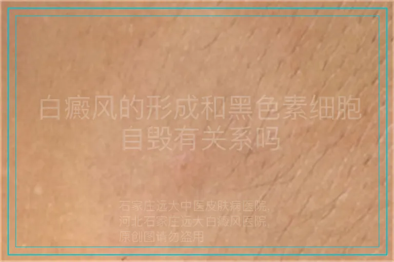 白癜风的形成和黑色素细胞自毁有关系吗