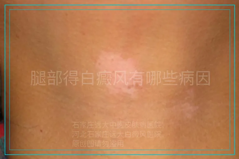 腿部得白癜风有哪些病因