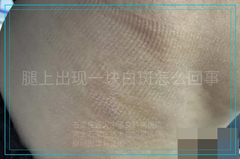 腿上出现一块白斑怎么回事