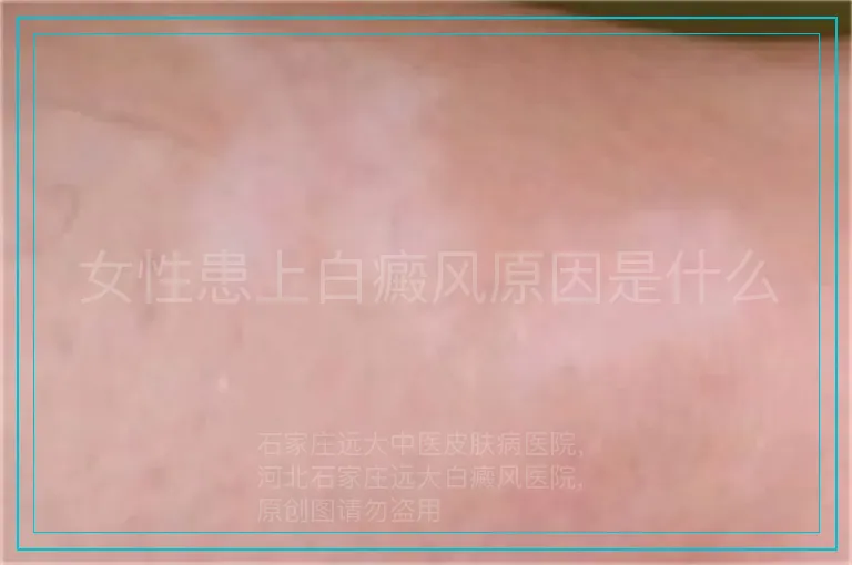 女性患上白癜风原因是什么