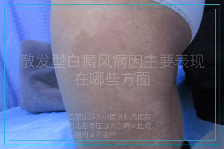 散发型白癜风病因主要表现在哪些方面