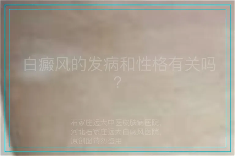 白癜风的发病和性格有关吗？