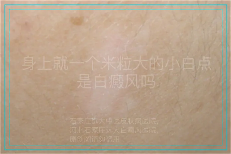 身上就一个米粒大的小白点是白癜风吗