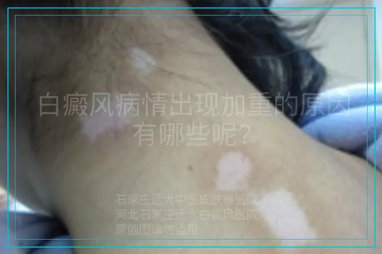 白癜风病情出现加重的原因有哪些呢?