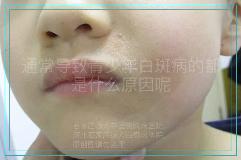通常导致青少年白斑病的都是什么原因呢
