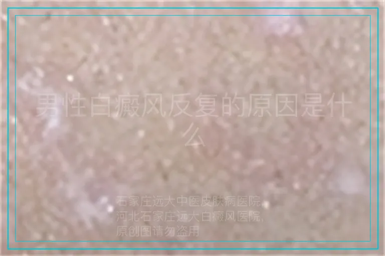 男性白癜风反复的原因是什么