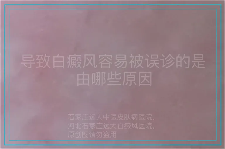 导致白癜风容易被误诊的是由哪些原因