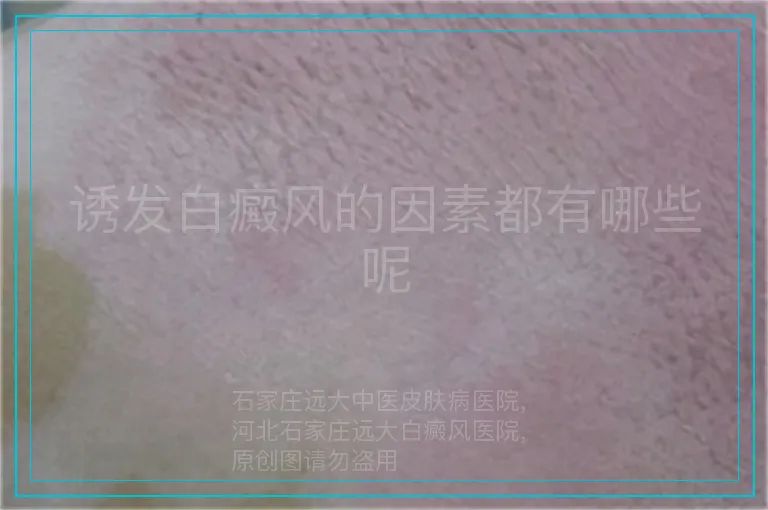 诱发白癜风的因素都有哪些呢