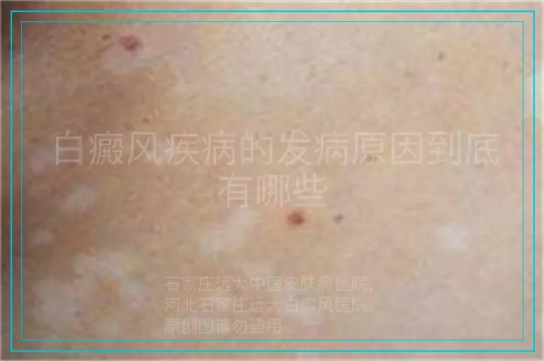 白癜风疾病的发病原因到底有哪些