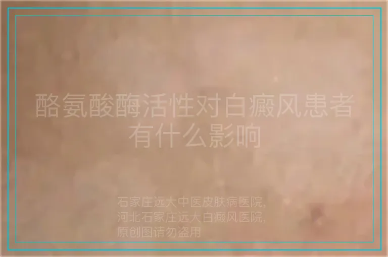 酪氨酸酶活性对白癜风患者有什么影响