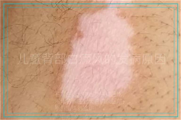 儿童背部白癜风的发病原因