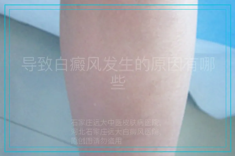 导致白癜风发生的原因有哪些
