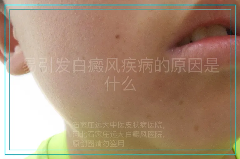 易引发白癜风疾病的原因是什么