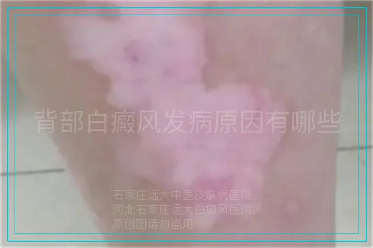 背部白癜风发病原因有哪些