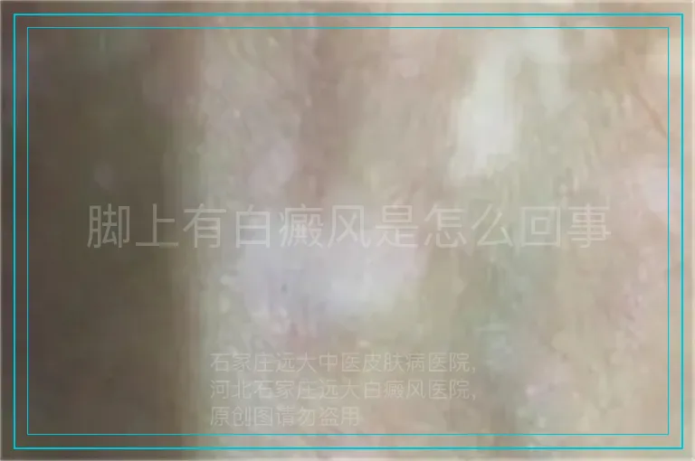 脚上有白癜风是怎么回事