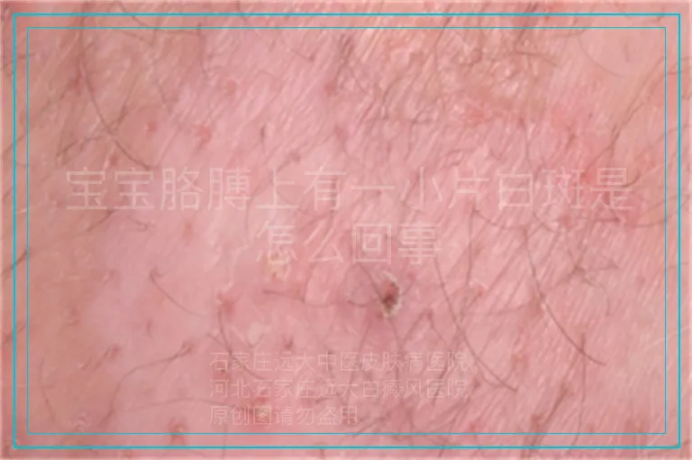 宝宝胳膊上有一小片白斑是怎么回事