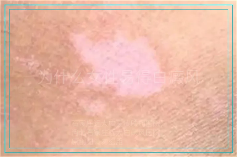 为什么女性易得白癜风