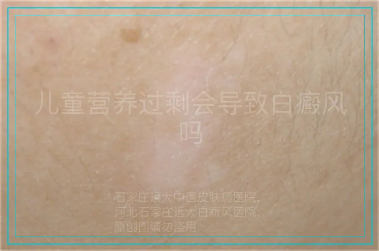 儿童营养过剩会导致白癜风吗