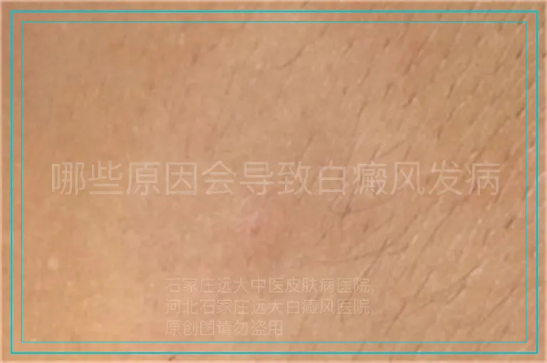 哪些原因会导致白癜风发病