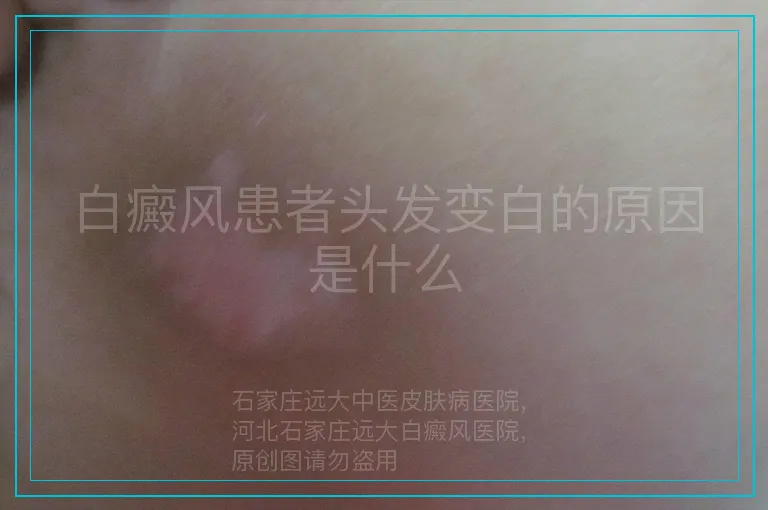 白癜风患者头发变白的原因是什么
