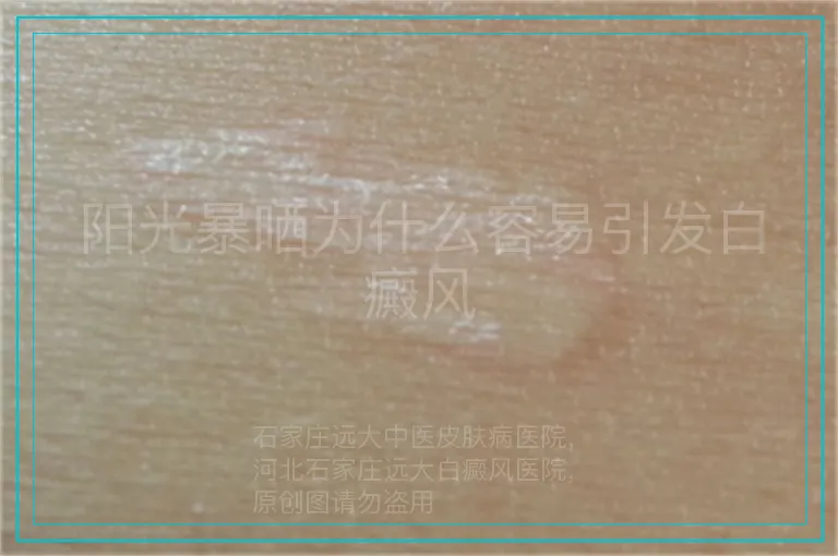 阳光暴晒为什么容易引发白癜风