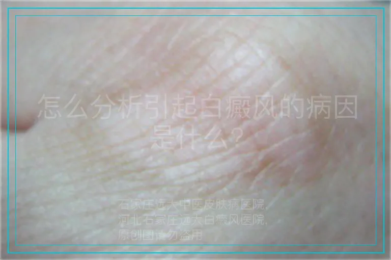怎么分析引起白癜风的病因是什么?