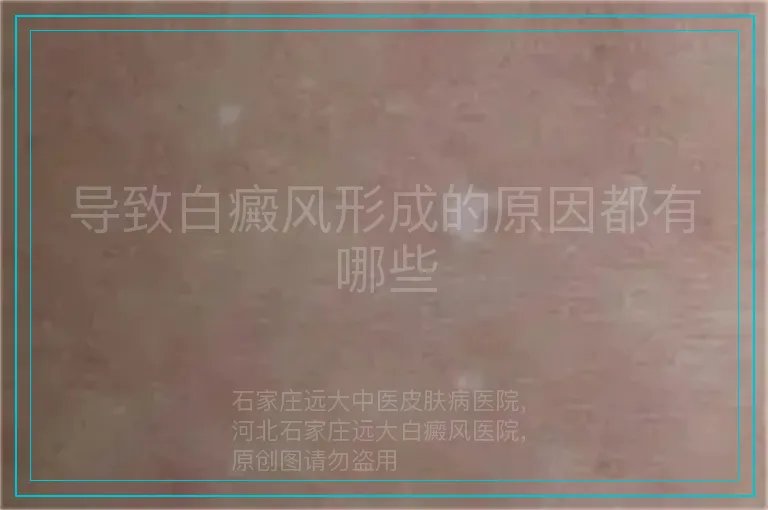 导致白癜风形成的原因都有哪些