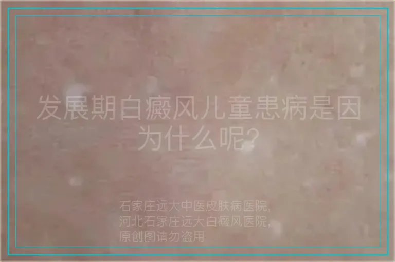 发展期白癜风儿童患病是因为什么呢?