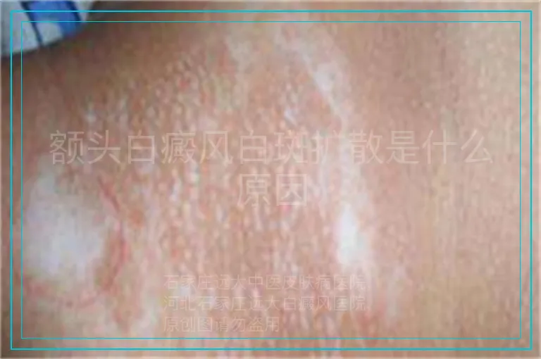 额头白癜风白斑扩散是什么原因