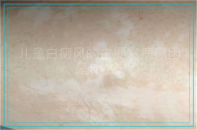 儿童白癜风的主要发病原因是什么?