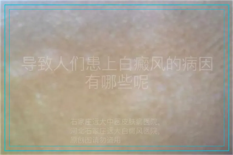 导致人们患上白癜风的病因有哪些呢